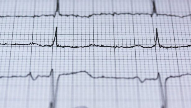 Ischemic Heart Disease